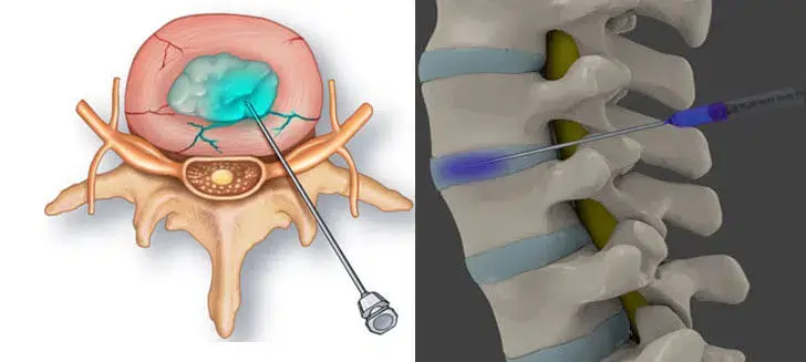 Clinician-administering-ozone-nucleolysis-to-the-targeted-area-of-the-spine