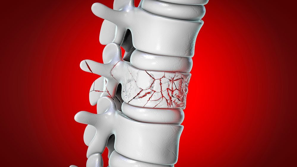 Vertebroplasty_1000x563