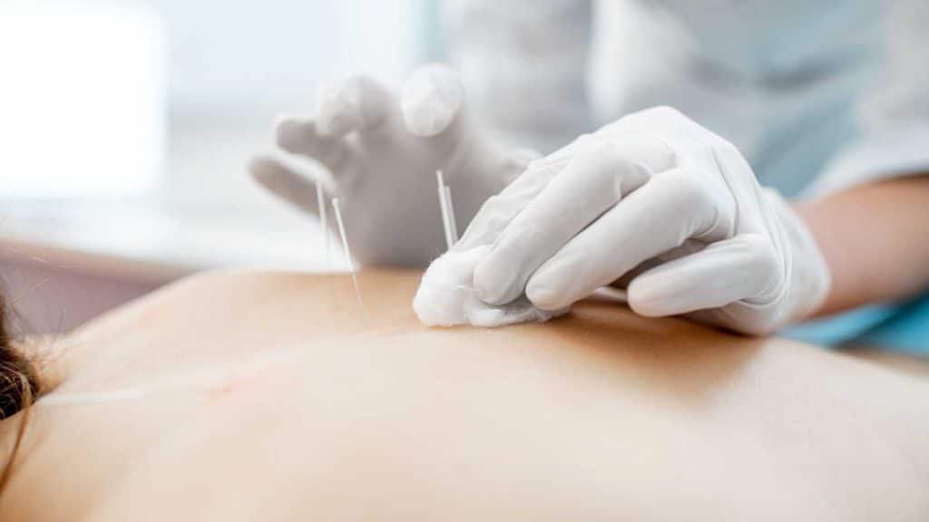 acupuncture-1024x576