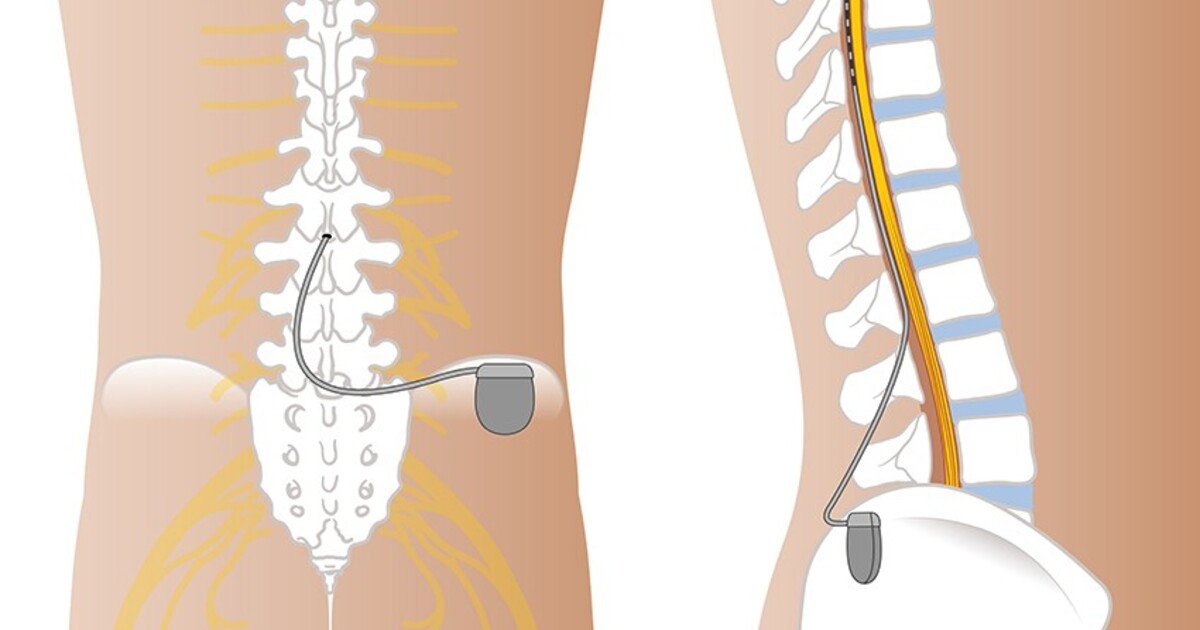 kov_ryggmargsstimulering_mot_periofere_nevorpatiske_smerter