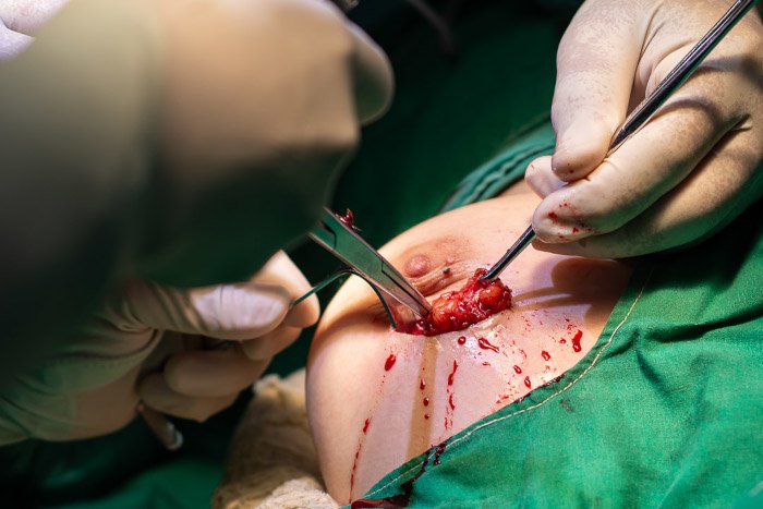 cancer surgery